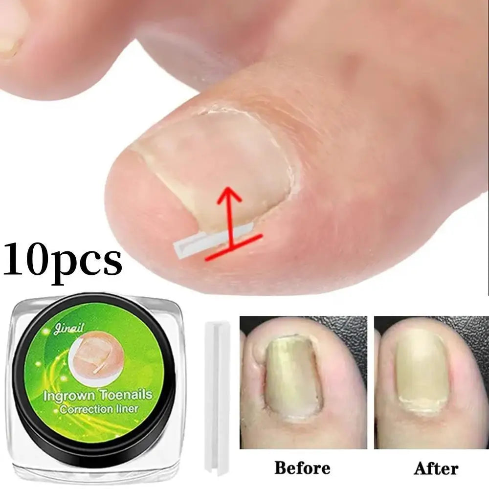 Hot Ingrown Toenail Corrector Nail Straighten Clip Ingrown Toenail Lifter Stainless Steel Paronychia Corrector Foot Care Tool