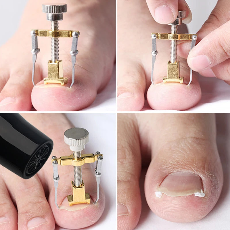 Hot Ingrown Toenail Corrector Nail Straighten Clip Ingrown Toenail Lifter Stainless Steel Paronychia Corrector Foot Care Tool